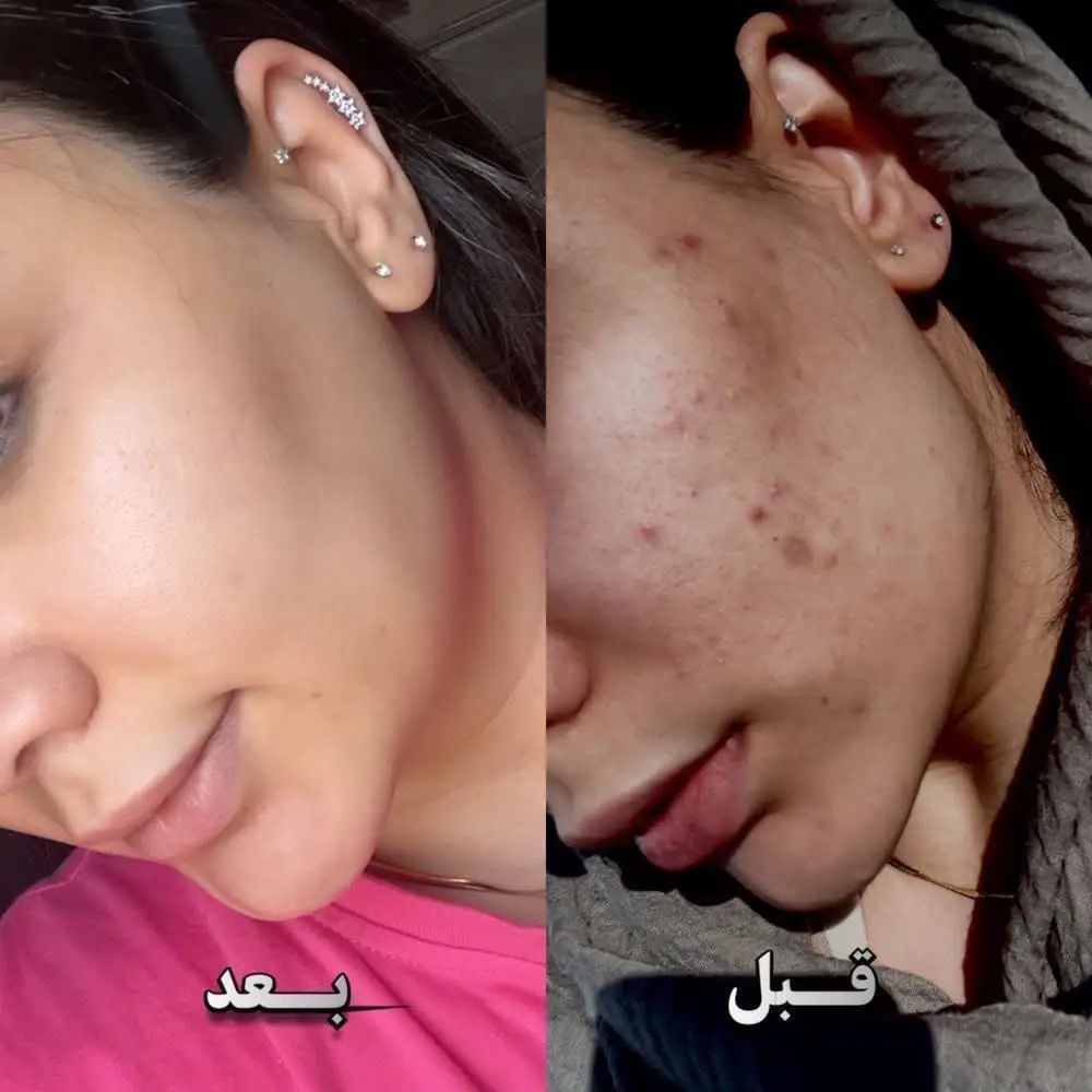 کرم ژل آنتی آکنه گاتیو — تصویر 5