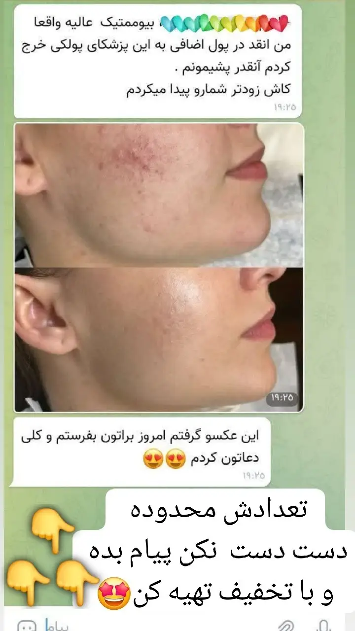کرم ژل آنتی آکنه گاتیو — تصویر 4