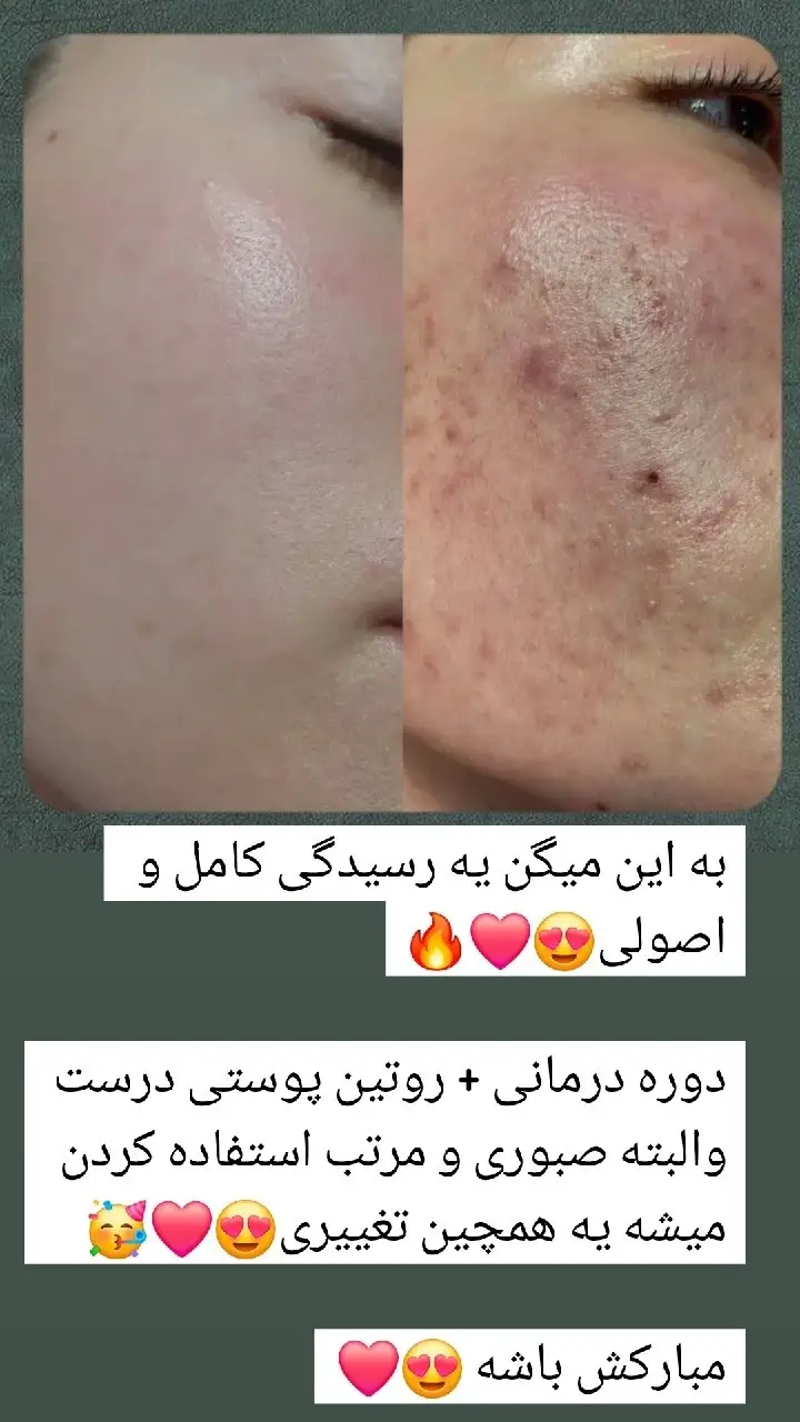 کرم ژل آنتی آکنه گاتیو — تصویر 6